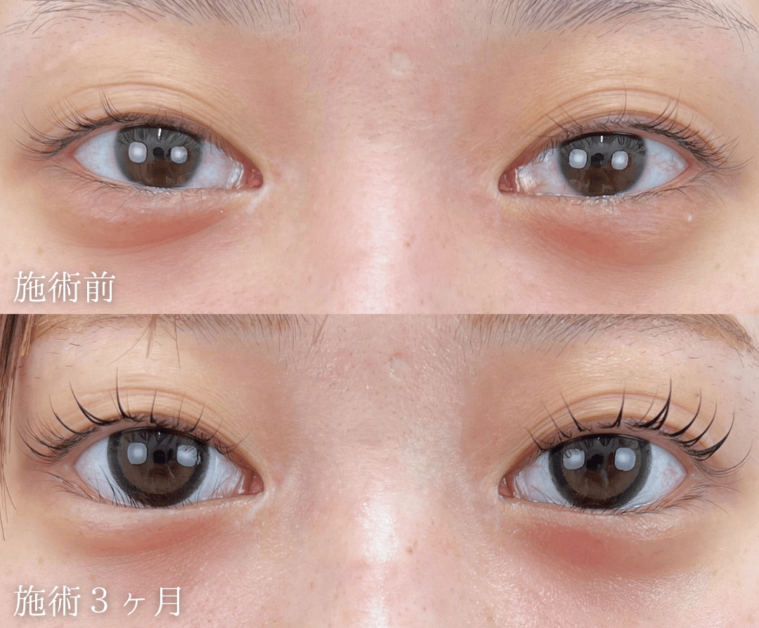 20代女性「優しい目元にしたい」